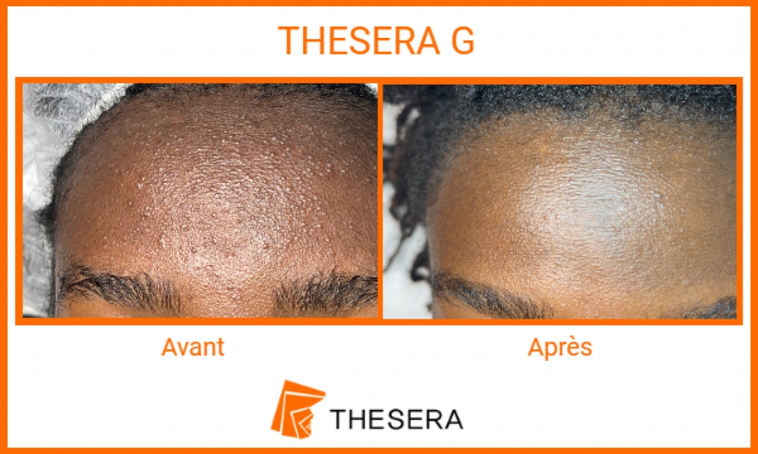 soin visage Thesera G avant-après
