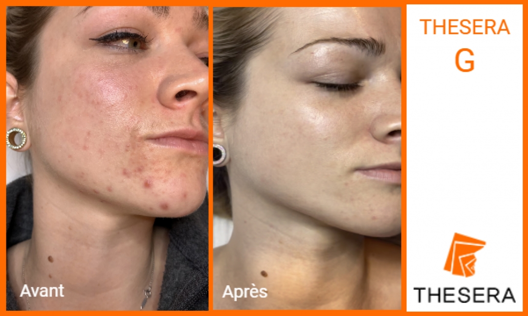 soin visage Thesera G avant-après