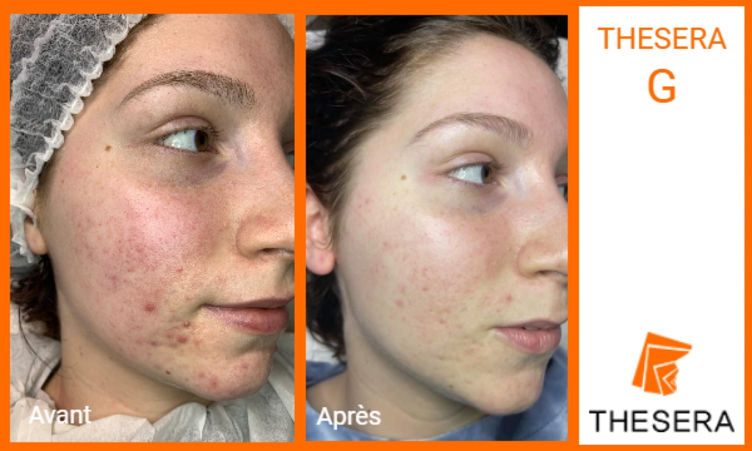 soin visage Thesera G avant-après